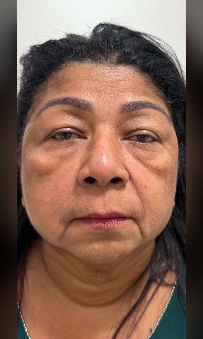 Antes: resultado de estética facial